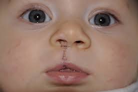 After a child has had surgery to close a cleft lip and/or palate, his or her parents may be concerned about how to look after him or her properly. Cleft Lip Palate Association
