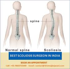 Best Scoliosis Surgeon In India Taking Special Care Of Spine In 2020 Scoliosis Scoliosis Surgery Surgery