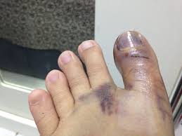 Sakit bila di bengkokkan, dibagian telapak juga sakit. Ambrynaa S Photo Diary Kemalangan Dalam Rumah Tulang Ibu Jari Retak