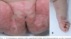 Some infants with congenital syphilis have symptoms at birth, but many. Figure 1 From Early Congenital Syphilis Presenting With Vesicobullous Eruptions Beyond Palmoplantar Regions Semantic Scholar