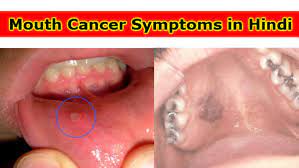 Depending on the area, patient will have a determined appearance, signs and symptoms. Janiye Jaanleva Bimari Mouth Cancer Symptoms In Hindi