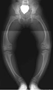 Infantile Blount S Disease Tibia Vara Pediatrics Orthobullets