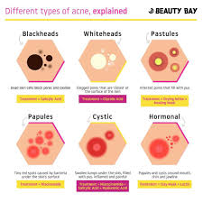 Different Types Of Acne And How To Treat Them Coolguides
