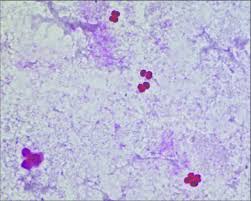 Examples are streptococcus pneumoniae, moraxella catarrhalis, neisseria gonorrhoeae. Gram Stain Showing Gram Negative Diplococci In Thrombus Download Scientific Diagram