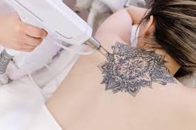 Navigating the Healing Journey: Laser Tattoo Removal Aftercare and Side  Effects - Kansas City Liposuction Clinic