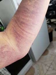 We did not find results for: Donated Plasma And They Messed Up The Needle Stick The Return Blood Went Into My Arm Instead Of Back Into The Vein I M Actually Surprised How Much It Hurts Wellthatsucks