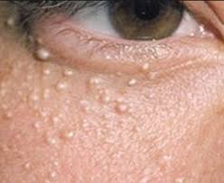 Small White Bumps On Face Bumps Under Eyes Pimples Under The Skin Skin Care Tips
