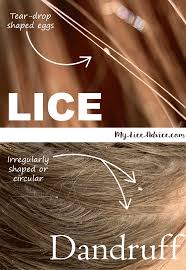 Is It Lice Or Dandruff Lice Eggs Dandruff Louse