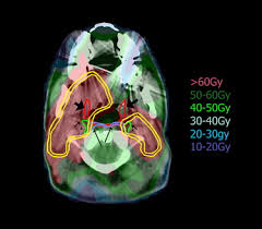 Image result for Intensity-Modulated Radiation Therapy