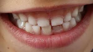 Karies Bei Kindern Was Tun