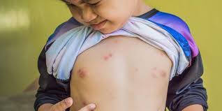 Jangan Panik Hadapi Cacar Air Pada Anak Ini Yang Bisa Dilakukan Orangtua