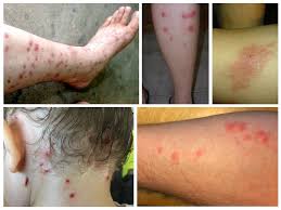 Difference between gnat bites and mosquito bites biting gnats, such as black flies and biting midges need blood to effectively reproduce. Do Gnats Bite Symptoms Treatments And Pictures
