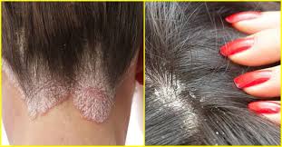 Men How To Treat Dandruff How To Treat Dandruff Does Dandruff By Anistone Jenifar Medium