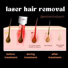Image result for Laser Hair Reduction