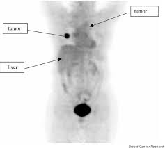 Fdg mimics glucose chemically and structurally. Positron Emission Tomography Agent 2 Deoxy 2 18 F Fluoro D Glucose Has A Therapeutic Potential In Breast Cancer Breast Cancer Research Full Text