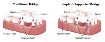 How long does it take for dental bridge to settle. Dental Bridges Bridgewater Va Harrisonburg Va