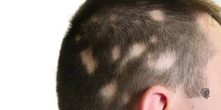 Thick hair is still possible. Is Alopecia Areata Caused Due To Psychological Factors Ahs India