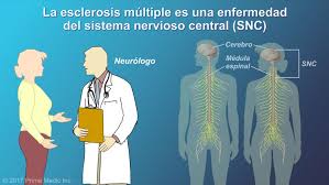 En argentina, la esclerosis múltiple (em) afecta entre 17.000 y 20.000 personas, de las cuales, 70% de son mujeres. Esclerosis Multiple Animado