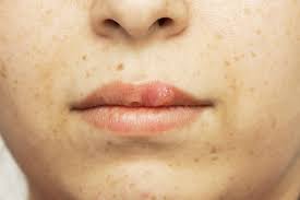 Image result for oral herpes symptoms roof of the mouth