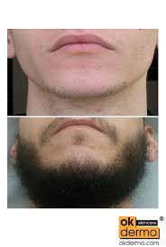 These are real before and after photos of real guys before applying minoxidil their faces and after using it for a period of time in order to grow their beards. Morr Topical Lotion 60ml 2fl Oz Okdermo Skin Care