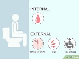 4 Manieres De Vous Debarrasser Rapidement Des Hemorroides