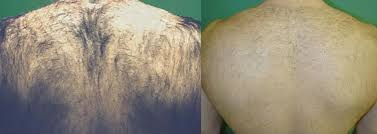Unlike laser hair removal, electrolysis treats all types of hair including blond, grey, and red hair. Laser Hair Removal Atlanta Medspa Laser Treatments