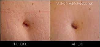 However, the existence of those white. Laser Stretch Mark Removal In Toronto Spamedica