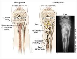 Image result for Osteomyelitis