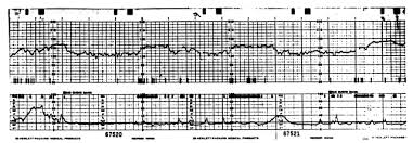 Image result for Contraction Stress Test