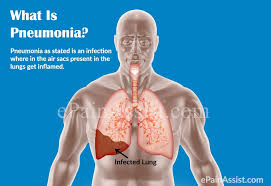 Check spelling or type a new query. Pneumonia Treatment Home Remedies Causes Symptoms Types