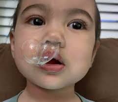 What is nose bleeding?