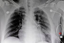 Image result for Thoracentesis