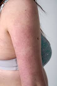 Image result for Keratosis pilaris
