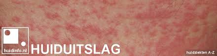 Afbeeldingsresultaat voor huiduitslag