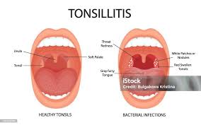 Image result for tonsilla palatina