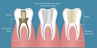 To thoroughly clean the area. Sore Discolored Tooth You Might Need Root Canal Therapy