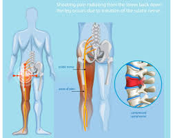 Image result for Sciatica