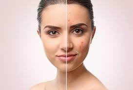 Sivilce Lekelerine Cozum Olan En Etkili 11 Maske Cilt Sitesi Acne Fighting Face Mask Diy Acne Acne Spots