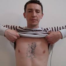Side Effects Of Rejuvi Tattoo Removal Dubai Abu Dhabi Dynamic Clinic