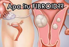 Seorang wanita bisa memiliki fibroid tunggal atau ganda. Makanan Penyebab Fibroid Makanan Kecutkan Fibroid