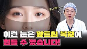 쌍수부분절개 & 앞트임 전후비교