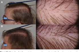 In fact, it affects as many as 6.8 million people in the u.s. Pdf Alopecia Areata Incognita And Diffuse Alopecia Areata Clinical Trichoscopic Histopathological And Therapeutic Features Of A 5 Year Study Semantic Scholar