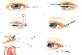 Our eye surgery in turkey uses the latest technology. Canthoplasty Turkey Istanbul Top 3 Clinics Prices
