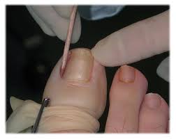 There are two ways to do it. Ingrown Toenails Academy Foot And Orthotic Clinics Toronto On Podiatrist