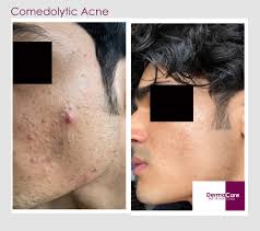 Image result for Comedolytic