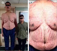 Pituitary Acrogigantism And Ectopic Cushing S Syndrome The Lancet Diabetes Endocrinology