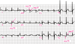 Mar 16, 2021 · la pericardite costrittiva cronica è una malattia rara che insorge lentamente; Pericardite Disturbi Dell Apparato Cardiovascolare Manuali Msd Edizione Professionisti