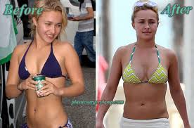 Résultat de recherche d'images pour "breast implant before and after"