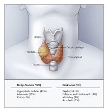 Mythyroid Com Thyroid Nodules