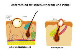Wie Unterscheidet Sich Ein Atherom Von Einem Pickel